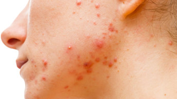 acne-tardiva-3